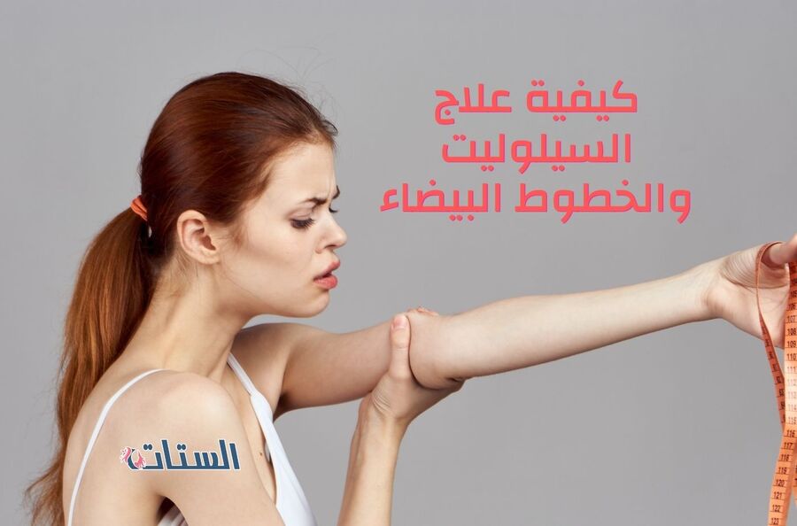 كيفية علاج السيلوليت والخطوط البيضاء